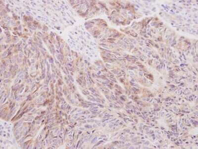 Immunohistochemistry-Paraffin: SIL1 Antibody [NBP2-20364] - human colon carcinoma, using SIL1 antibody at 1:250 dilution. Antigen Retrieval: Trilogy™ (EDTA based, pH 8.0) buffer, 15min.