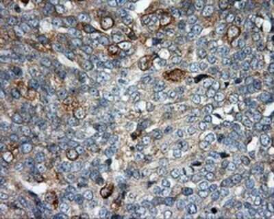 Immunohistochemistry: SIL1 Antibody (OTI3E3) - Azide and BSA Free [NBP2-74193] - Staining of paraffin-embedded Adenocarcinoma of ovary tissue using anti-SIL1 mouse monoclonal antibody.