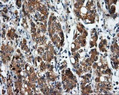 Immunohistochemistry: SIL1 Antibody (OTI3E3) - Azide and BSA Free [NBP2-74193] - Staining of paraffin-embedded Carcinoma of liver tissue using anti-SIL1 mouse monoclonal antibody.