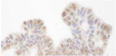 Immunohistochemistry-Paraffin: SIN3A Antibody [NB100-2252] - FFPE section of human ovarian tumor.  Rabbit anti-SIN3A Antibody used at a dilution of 1:250.