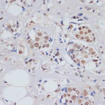 Immunohistochemistry-Paraffin: SKIV2L2 Antibody [NBP2-94315] - Human breast cancer using SKIV2L2 antibody at dilution of 1:100 (40x lens).