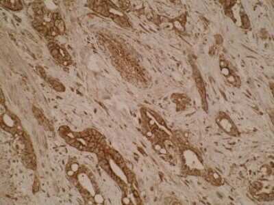 Immunohistochemistry: SLA2 Antibody (Z30P1F12/F4) [NBP2-50293] - Analysis of pancreatic adenocarcinoma tissue using anti-SLA2 [Z30P1F12 F4]. Cytoplasmic staining was observed.