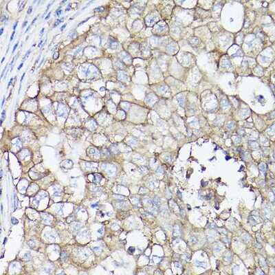 Immunohistochemistry-Paraffin: SLC16A3 Antibody [NBP2-94186] - Immunohistochemistry of paraffin-embedded human breast cancer using SLC16A3 Rabbit pAb (NBP2-94186) at dilution of 1:100 (40x lens). Perform high pressure antigen retrieval with 10 mM citrate buffer pH 6.0 before commencing with IHC staining protocol.