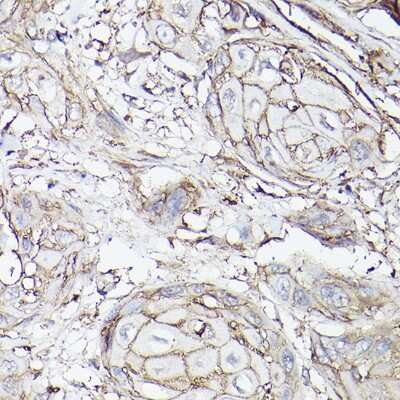 Immunohistochemistry-Paraffin: SLC16A3 Antibody [NBP2-94186] - Immunohistochemistry of paraffin-embedded human esophageal cancer using SLC16A3 Rabbit pAb (NBP2-94186) at dilution of 1:100 (40x lens). Perform high pressure antigen retrieval with 10 mM citrate buffer pH 6.0 before commencing with IHC staining protocol.