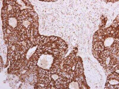 Immunohistochemistry-Paraffin: SLC25A22 Antibody [NBP1-33385] - SLC25A22 antibody detects SLC25A22 protein at mitochondria in human colon carcinoma by immunohistochemical analysis. Sample: Paraffin-embedded human colon carcinoma. SLC25A22 antibody diluted at 1:500.