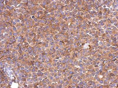 Immunohistochemistry-Paraffin: SLC25A46 Antibody [NBP2-20392] - Immunohistochemical analysis of paraffin-embedded Huh-7 xenograft, using antibody at 1:500 dilution.