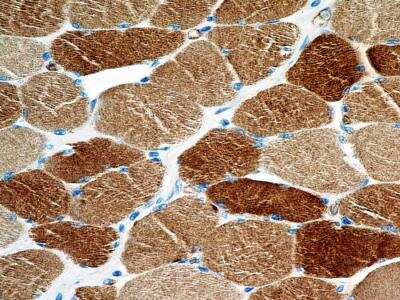 Immunohistochemistry-Paraffin: SLC31A1/CTR1 Antibody (3C7.1B7) [NBP2-36574] - Analysis of a FFPE tissue section of human skeletal muscle from a breast cancer patient (NBP2-30234) using purified CTR1/SLC31A1 antibody clone 3C7.1B7 at 5 ug/mL. The antibody generated moderate to strong cytoplasmic staining in the muscle cells/ myocytes.
