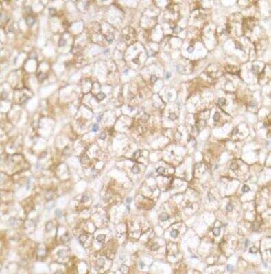 Immunohistochemistry-Paraffin: SLC39A14 Antibody [NBP2-93483] -  Human liver cancer using ZIP14 Rabbit pAb at dilution of 1:50 (40x lens).Perform high pressure antigen retrieval with 10 mM citrate buffer pH 6.0 before commencing with IHC staining protocol.