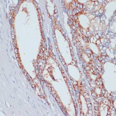 Immunohistochemistry-Paraffin: SLC39A4/ZIP4 Antibody [NBP2-94856] - Human colon carcinoma using SLC39A4 antibody at dilution of 1:100 (40x lens).