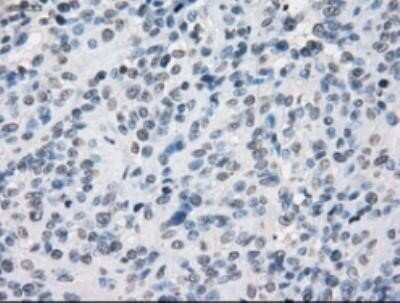 Immunohistochemistry: SLC7A8 Antibody (OTI7D6) - Azide and BSA Free [NBP2-74215] - Carcinoma of bladder tissue.