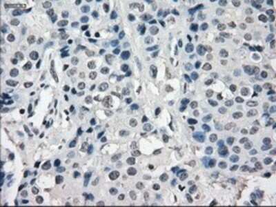 Immunohistochemistry: SLC7A8 Antibody (OTI7D6) - Azide and BSA Free [NBP2-74215] - Staining of paraffin-embedded Adenocarcinoma of breast tissue using anti-SLC7A8 mouse monoclonal antibody.