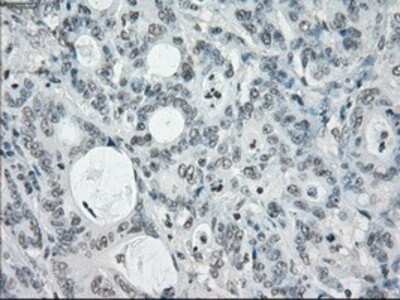 Immunohistochemistry: SLC7A8 Antibody (OTI7D6) - Azide and BSA Free [NBP2-74215] - Staining of paraffin-embedded Adenocarcinoma of colon tissue using anti-SLC7A8 mouse monoclonal antibody.