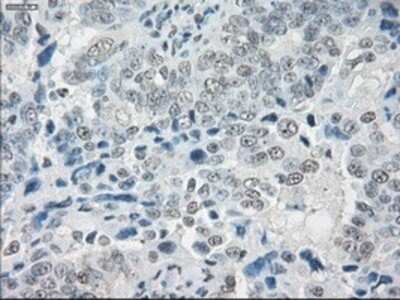 Immunohistochemistry: SLC7A8 Antibody (OTI7D6) - Azide and BSA Free [NBP2-74215] - Staining of paraffin-embedded Adenocarcinoma of ovary tissue using anti-SLC7A8 mouse monoclonal antibody.