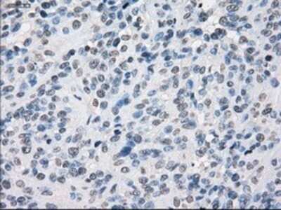 Immunohistochemistry: SLC7A8 Antibody (OTI7D6) - Azide and BSA Free [NBP2-74215] - Staining of paraffin-embedded Carcinoma of bladder tissue using anti-SLC7A8 mouse monoclonal antibody.