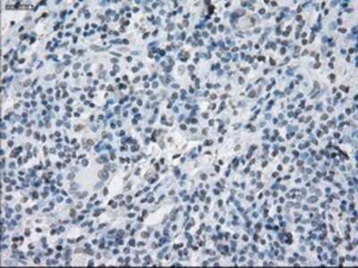 Immunohistochemistry: SLC7A8 Antibody (OTI7D6) - Azide and BSA Free [NBP2-74215] - Staining of paraffin-embedded Carcinoma of thyroid tissue using anti-SLC7A8 mouse monoclonal antibody.