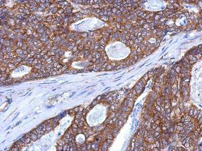 Immunohistochemistry-Paraffin: SLITRK5 Antibody [NBP2-20400] - Immunohistochemical analysis of paraffin-embedded Gastric ca, using antibody at 1:500 dilution.