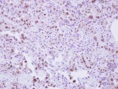 Immunohistochemistry-Paraffin: SLU7 Antibody [NBP2-20402] - Immunohistochemical analysis of paraffin-embedded Lung AdCA, using antibody at 1:250 dilution.