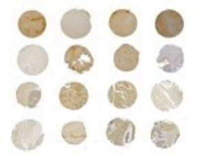 Immunohistochemistry-Paraffin: SMAC/Diablo Antibody [NB100-56164] - Formalin-fixed, paraffin-embedded tissue cores from a human breast cancer microarray stained for Smac/Diablo using NB100-56164 at 1:2000. Hematoxylin-eosin counterstain.  Differential Smac/DIABLO staining is seen between patient samples.
