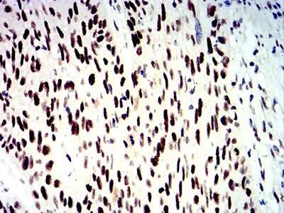 Immunohistochemistry-Paraffin: SMARCA1 Antibody (2H7B9) [NBP2-61882] - Analysis of esophageal cancer tissues using SMARCA1 mouse mAb with DAB staining.