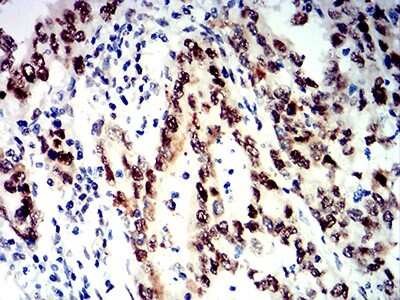 Immunohistochemistry-Paraffin: SMARCA1 Antibody (2H7B9) [NBP2-61882] - Analysis of stomach cancer tissues using SMARCA1 mouse mAb with DAB staining.