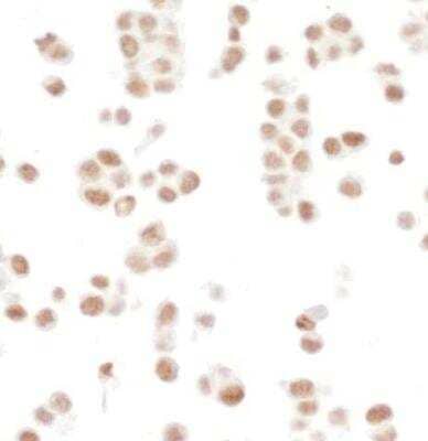 Immunocytochemistry: SMC1 Antibody (BL-205-2G8) [NBP2-76412] - Detection of human SMC1 in FFPE HCT 116 cells by ICC. Antibody: Rabbit anti-SMC1 recombinant monoclonal [BL-205-2G8] (NBP2-76412). Secondary: HRP-conjugated goat anti-rabbit IgG. Substrate: DAB.