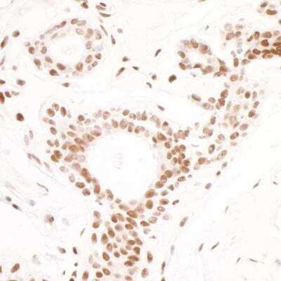 Immunohistochemistry: SMC1 Antibody (BL-205-2G8) [NBP2-76412] - Detection of human SMC1 in FFPE breast carcinoma by IHC. Antibody: Rabbit anti-SMC1 recombinant monoclonal [BL-205-2G8] (NBP2-76412). Secondary: HRP-conjugated goat anti-rabbit IgG. Substrate: DAB.