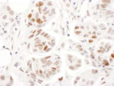 Immunohistochemistry: SMC1 Antibody [NBP2-32142] - Sample: FFPE section of human ovarian carcinoma. Antibody: Affinity purified rabbit anti- Phospho SMC1 (S957) used at a dilution of 1:5,000 (0.2ug/ml). Detection: DAB. Counterstain: Hematoxylin (blue).