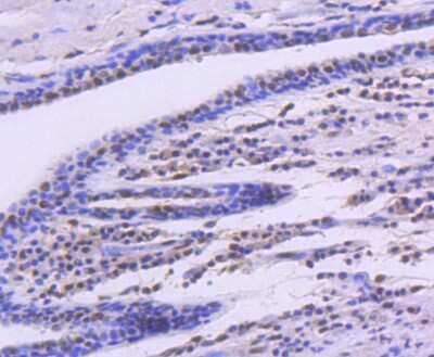 Immunohistochemistry-Paraffin: SMC1 Antibody (SN20-27) [NBP2-67733] - Analysis of paraffin-embedded human breast carcinoma tissue using anti-SMC1 antibody. Counter stained with hematoxylin.