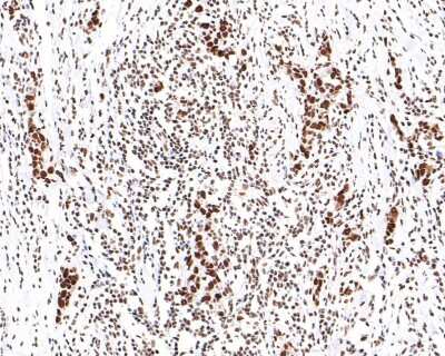 Immunohistochemistry-Paraffin: SMC1 Antibody (SN20-27) [NBP2-67733] - Analysis of paraffin-embedded human breast carcinoma tissue with Rabbit anti-SMC1 antibody washed with ddH2O and PBS, and then probed with the primary antibody  at 1/400 dilution for 1 hour at room temperature. The detection was performed using an HRP conjugated compact polymer system. DAB was used as the chromogen. Tissues were counterstained with hematoxylin and mounted with DPX.
