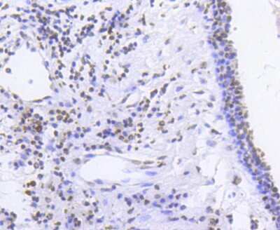 Immunohistochemistry-Paraffin: SMC1 [p Ser957] Antibody (SC65-03) [NBP2-67598] - Analysis of paraffin-embedded human breast carcinoma tissue using anti- phospho -SMC1(S957) antibody. Counter stained with hematoxylin.