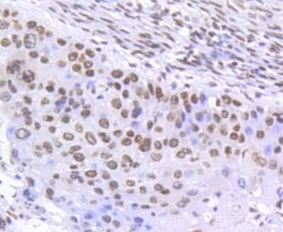 Immunohistochemistry-Paraffin: SMC1 [p Ser957] Antibody (SC65-03) [NBP2-67598] - Analysis of paraffin-embedded human lung cancer tissue using anti- phospho -SMC1(S957) antibody. Counter stained with hematoxylin.