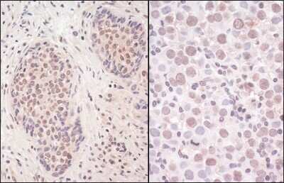 <b>Independent Antibodies Validation and Biological Strategies Validation.</b>Immunohistochemistry: SMCHD1 Antibody [NBP1-49969] - Sample: FFPE section of human non-small cell lung cancer (left) and testicular seminoma (right). Antibody: Affinity purified rabbit anti- SmcHD1 used at a dilution of 1:200 (1ug/ml). Detection: Vector Laboratories ImmPACT NovaRED Peroxidase Substrate