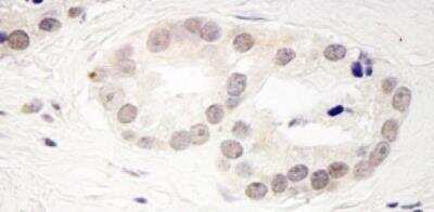 Immunohistochemistry-Paraffin: SMEK2 Antibody [NB100-2881] - : FFPE section of human prostate carcinoma.