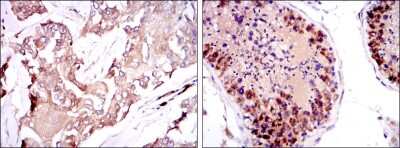 Immunohistochemistry: SMN Antibody (5H1) [NBP2-37594] - Immunohistochemical analysis of paraffin-embedded breast cancer tissues (left) and testis tissues (right) using SMN1 mouse mAb with DAB staining.