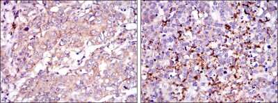 Immunohistochemistry: SMN Antibody (5H1) [NBP2-37594] - Immunohistochemical analysis of paraffin-embedded stomach cancer tissues (left) and brain tumor (right) using SMN1 mouse mAb with DAB staining.