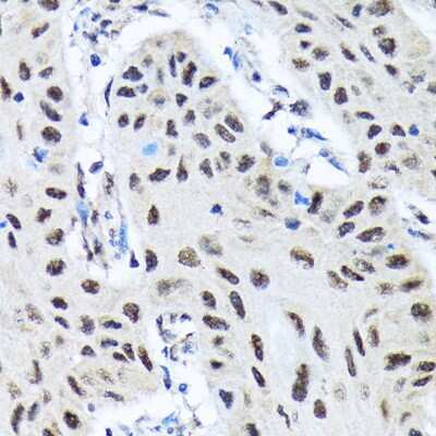 Immunohistochemistry-Paraffin: SMN Antibody (9N9Q6) [NBP3-16863] - Immunohistochemistry of paraffin-embedded human lung cancer using SMN Rabbit mAb (NBP3-16863) at dilution of 1:100 (40x lens).Perform microwave antigen retrieval with 10 mM Tris/EDTA buffer pH 9.0 before commencing with IHC staining protocol.