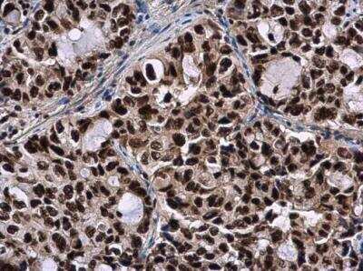 Immunohistochemistry-Paraffin: SMNDC1 Antibody [NBP2-20424] - Human lung cancer. SMNDC1 antibody [N1C3-2] diluted at 1:500. Antigen Retrieval: Citrate buffer, pH 6.0, 15 min. 