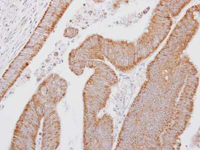 Immunohistochemistry-Paraffin: SMOC-1 Antibody [NBP2-15123] -  Human colon carcinoma, using SMOC1 antibody at 1:250 dilution. Antigen Retrieval: Trilogy™ (EDTA based, pH 8.0) buffer, 15min