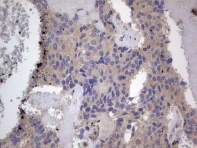 Immunohistochemistry: SMPD1 Antibody (OTI3H7) - Azide and BSA Free [NBP2-74240] - Analysis of Adenocarcinoma of Human breast tissue. (Heat-induced epitope retrieval by 1 mM EDTA in 10mM Tris, pH8.5, 120C for 3min)