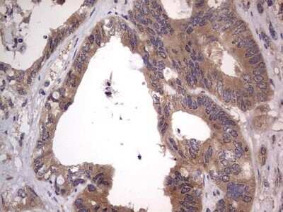 Immunohistochemistry: SMPD1 Antibody (OTI3H7) - Azide and BSA Free [NBP2-74240] - Analysis of Adenocarcinoma of Human colon tissue. (Heat-induced epitope retrieval by 1 mM EDTA in 10mM Tris, pH8.5, 120C for 3min)