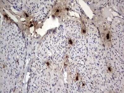 Immunohistochemistry: SMPD1 Antibody (OTI3H7) - Azide and BSA Free [NBP2-74240] - Analysis of Adenocarcinoma of Human endometrium tissue. (Heat-induced epitope retrieval by 1 mM EDTA in 10mM Tris, pH8.5, 120C for 3min)