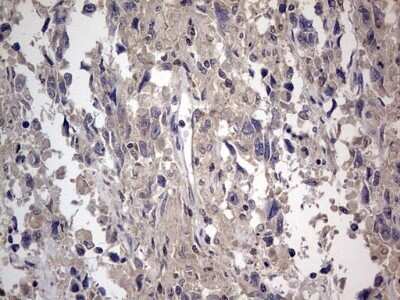 Immunohistochemistry: SMPD1 Antibody (OTI3H7) - Azide and BSA Free [NBP2-74240] - Analysis of Adenocarcinoma of Human ovary tissue. (Heat-induced epitope retrieval by 1 mM EDTA in 10mM Tris, pH8.5, 120C for 3min)