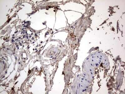 Immunohistochemistry: SMPD1 Antibody (OTI3H7) - Azide and BSA Free [NBP2-74240] - Analysis of Carcinoma of Human kidney tissue. (Heat-induced epitope retrieval by 1 mM EDTA in 10mM Tris, pH8.5, 120C for 3min)