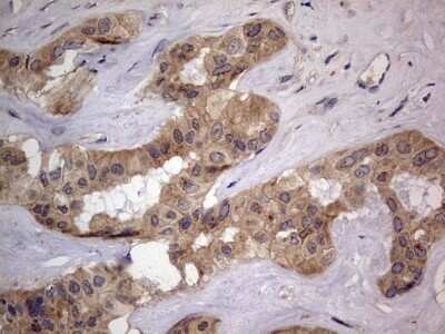 Immunohistochemistry: SMPD1 Antibody (OTI3H7) - Azide and BSA Free [NBP2-74240] - Analysis of Carcinoma of Human liver tissue.(Heat-induced epitope retrieval by 1 mM EDTA in 10mM Tris, pH8.5, 120C for 3min)