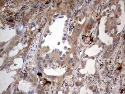 Immunohistochemistry: SMPD1 Antibody (OTI3H7) - Azide and BSA Free [NBP2-74240] - Analysis of Carcinoma of Human lung tissue.(Heat-induced epitope retrieval by 1 mM EDTA in 10mM Tris, pH8.5, 120C for 3min)