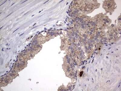 Immunohistochemistry: SMPD1 Antibody (OTI3H7) - Azide and BSA Free [NBP2-74240] - Analysis of Carcinoma of Human prostate tissue. (Heat-induced epitope retrieval by 1 mM EDTA in 10mM Tris, pH8.5, 120C for 3min)