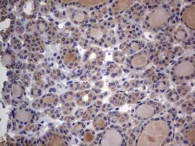 Immunohistochemistry: SMPD1 Antibody (OTI3H7) - Azide and BSA Free [NBP2-74240] - Analysis of Carcinoma of Human thyroid tissue. (Heat-induced epitope retrieval by 1 mM EDTA in 10mM Tris, pH8.5, 120C for 3min)