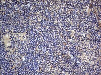 Immunohistochemistry: SMPD1 Antibody (OTI3H7) - Azide and BSA Free [NBP2-74240] - Analysis of Human lymphoma tissue. (Heat-induced epitope retrieval by 1 mM EDTA in 10mM Tris, pH8.5, 120C for 3min)