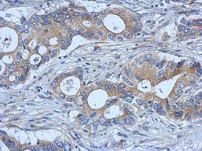 Immunohistochemistry-Paraffin: SMURF2 Antibody [NBP2-20427] - Human gastric cancer, using SMURF2 antibody at 1:500 dilution. Antigen Retrieval: Trilogy™ (EDTA based, pH 8.0) buffer, 15min. 