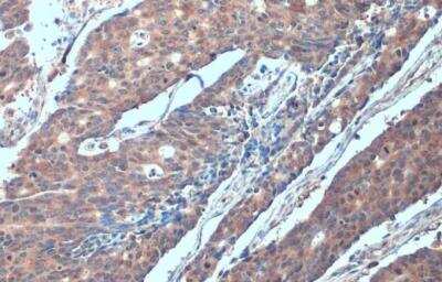 Immunohistochemistry-Paraffin: SMURF2 Antibody [NBP2-20427] - Human colon cancer. SMURF2 stained by SMURF2 antibody [N3C2], Internal diluted at 1:500. Antigen Retrieval: Citrate buffer, pH 6.0, 15 min. 